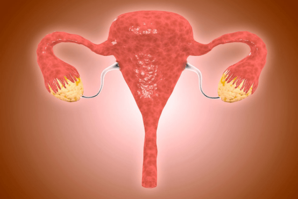Diet and Lifestyle Tips for Polycystic Ovaries